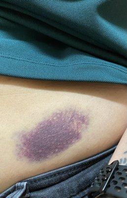 The bruise from the sudden stop