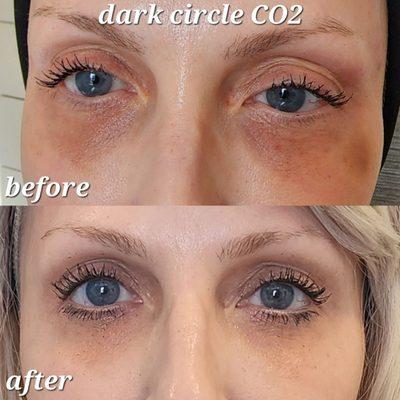 CO2 Laser resurfacing- Under eyes before and after