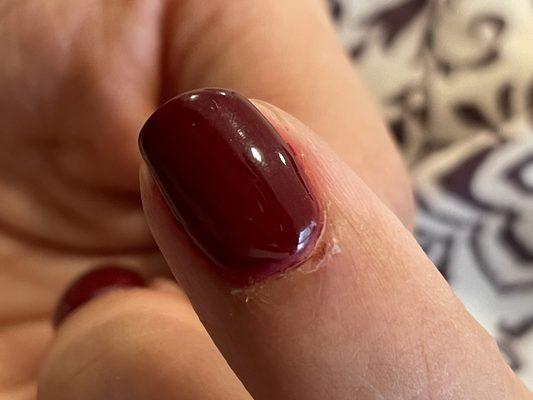 Bleeding nail bed