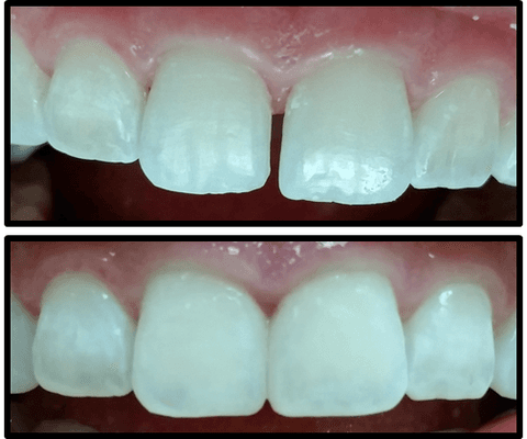 Patient has always been conscious of the "gap in between two front teeth" (diastema).  We did some bond in one visit and patient was happy!