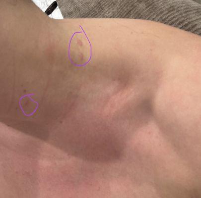 This is one side of the scars left from their skin tag removal.