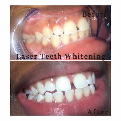 Laser Teeth Whitening