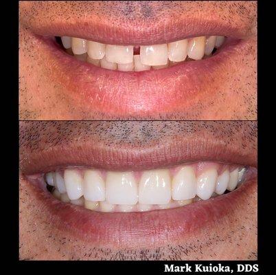 Naturally esthetic porcelain veneers helped to close spaces and improve tooth color. Veneers preserve more tooth structure than crowns.