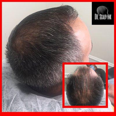 Density enhancement upper scalp blended to natural receding hairline