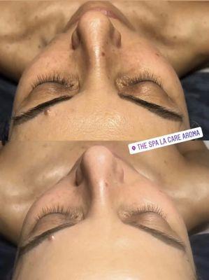 hydrodermabrasion Treatment