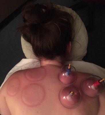 Cupping!