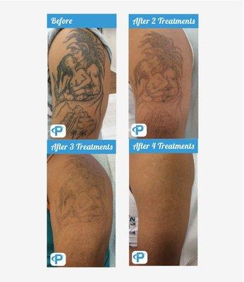 After four laser treatments, this tattoo almost vanished. To clear the tattoo completely, we performed one more treatment.