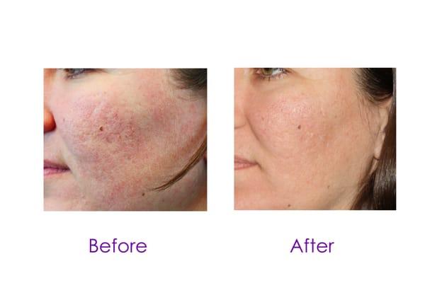 Microneedling