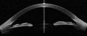 Anterior segment OCT