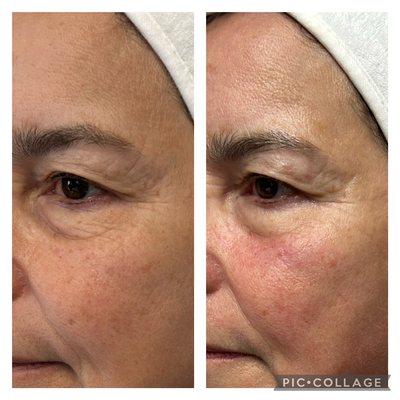 Every wrinkle tells a story, but it's time for a plot twist and a time turn-around with V-ST Treatment!