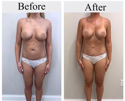 Before and After:
Procedure: Mommy Makeover
This patient did a Tummy Tuck with Removal and Replacement of Silicone Breast Implants