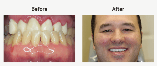 We used porcelain veneers to improve the appearance of his smile.