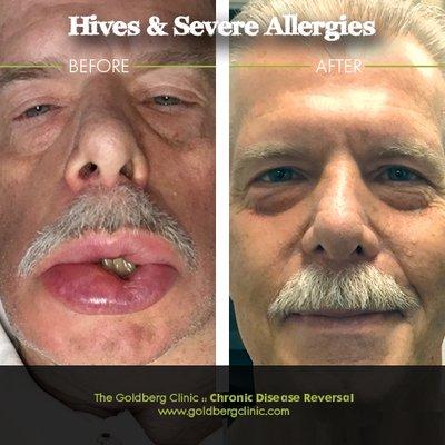 Hives and Allergies Before and After