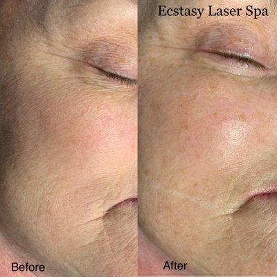 Laser Skin Tightening At Ecstasy Laser Spa