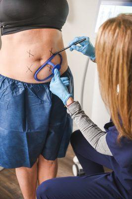 Let us show you the areas we can help you eliminate with CoolSculpting.