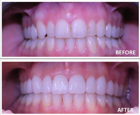 Patient had leaking composite fillings on all upper front teeth. 8 veneers were completed. Patient was ecstatic about the results!