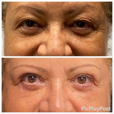 Eyelid lift before and after