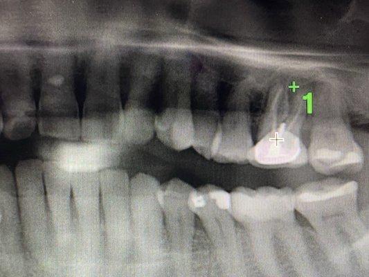 Tooth #14 with 4 roots , 2 failed root canals ,2 or 3 crowns , now its gone .