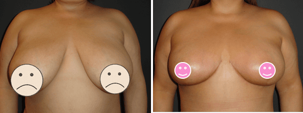 Dr. DeVito Breast Reduction Before and After