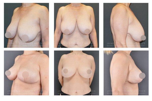 Breast Lift Breast Reduction Liposuction of breast LipoLift Ptosis correction