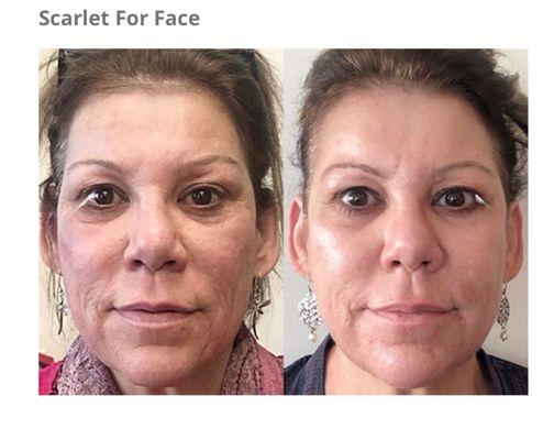 Scarlett RF micro needling is a non-invasive treatment that combines microneedling with (RF) energy to rejuvenate and tighten the skin