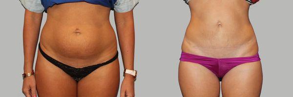 Before and After Tummy Tuck (abdominoplasty) by Dr. David Feldmar | Feldmar Aesthetics