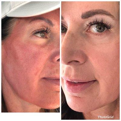 Left-one day post Microneedling, Right-two days post!