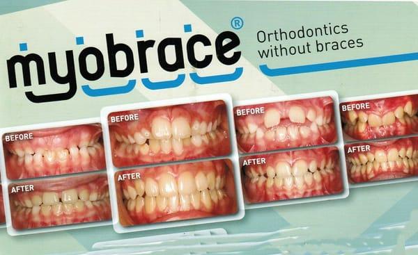 Our all natural orthodontics program called Myobrace that gets to the root cause of crooked teeth instead of treating the symptom.