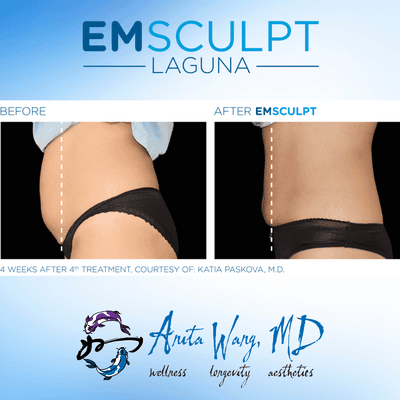 Emsculpt Abs