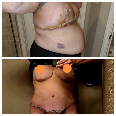 Top photo.. breast reduction 3 weeks out.  Bottom photo after weight loss and panniculectomy .