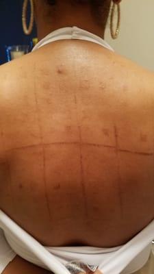 My back post-PATCH TEST.  The DERMATOLOGIST did this to my back!  He was supposed to remove it sooner.