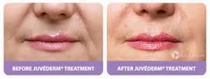 Juvederm for Nasolabial Fold Before & After