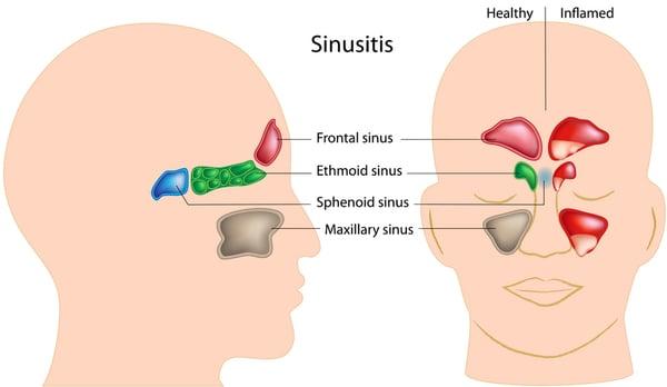 Sinus Survival