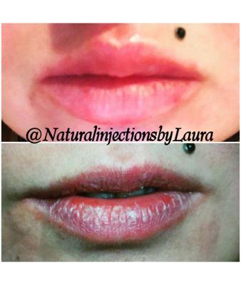 Lip filler! Before Bottom, After Top