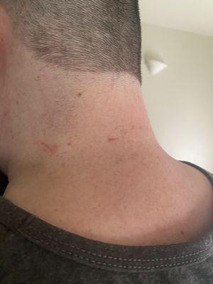 Red marks on neck, after after haircut