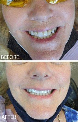 uneven color & sized teeth has made beautiful with pearly porcelain veneers!