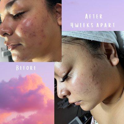 Acne customized treatment; Before & after 2 facials, and customized skin care regimen