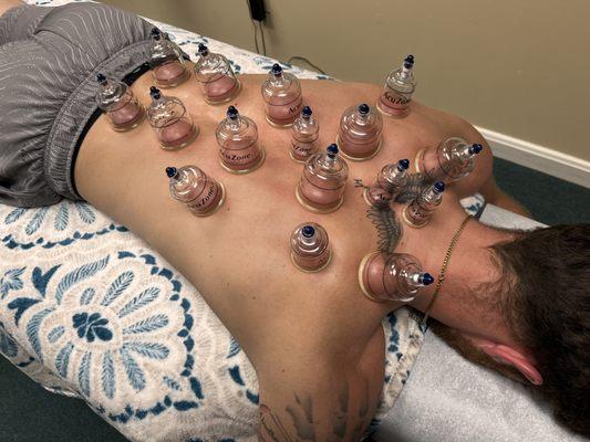 Cupping