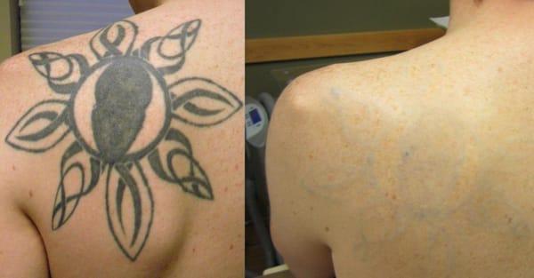 Shoulder tattoo removal