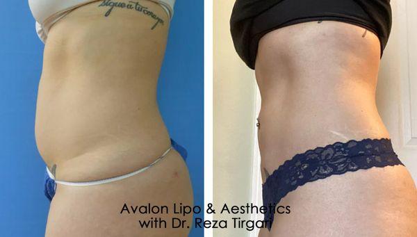 Before & After Liposuction with Dr. Tirgari - www.lipoandaesthetics.com - Abdomen