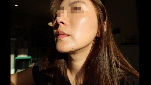 after ultherapy (elastic, firm, healthy, glow)