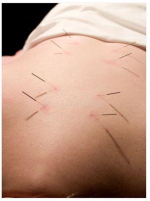 Acupuncture treatment on the back