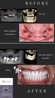 All on 4 dental implants, stabilize loose dentures with dental implants, smile makeover, new smile.