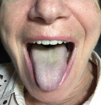 This is my tongue with visible purplish coat, suggesting liver troubles.