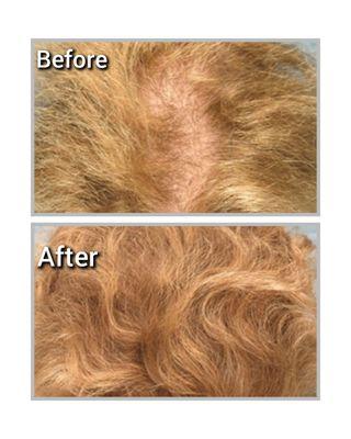 Hair Restoration