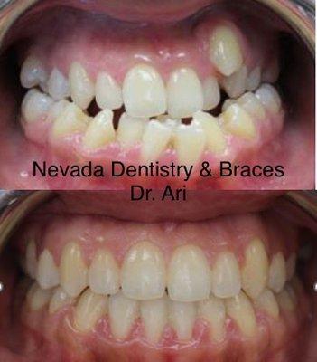 Crowding and cross bite correction in adult patient!
We finished this case in 24 months