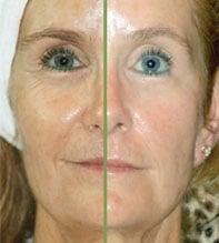 SWiCH Facial Peel Results (series of 6)