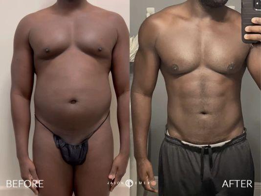 Gladiator High Def Lipo for male patient who wanted to be more fit and athletic with natural sculpting