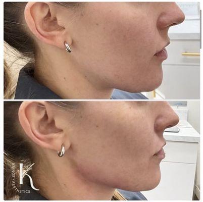 Jawline filler