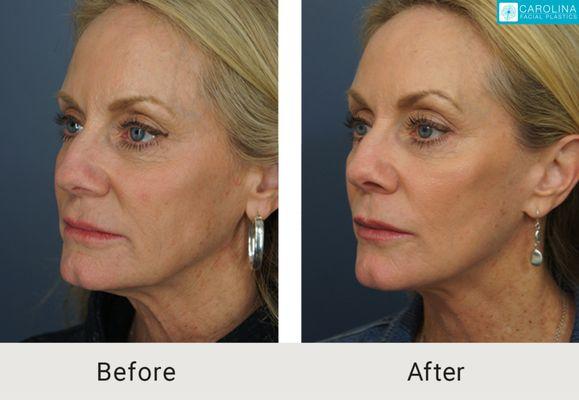 Mini facelift for facial rejuvenation.